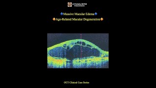 Massive Macular Edema AgeRelated Macular Degeneration [upl. by Sitoeht]