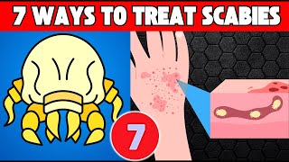 7 Best Ways To Treat Scabies Faster Get relief from itch [upl. by Marb]