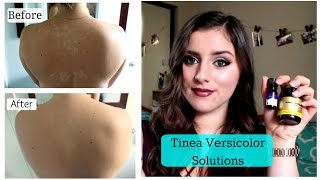 Tinea Versicolor SOLUTIONS TNBeauty94 [upl. by Atteinotna]