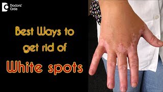 How to treat white spots on the skin  Dr Rasya Dixit [upl. by Koetke]