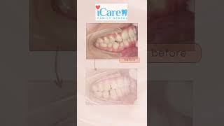 Free Invisalign consultation at iCare Family Dental Valued at 599 dentist dentalcare [upl. by Eloc]