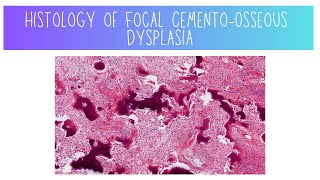 Histology of Focal CementoOsseous Dysplasia [upl. by Philly487]