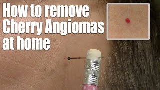 How to remove Red Skin Dots at home Quick amp Easy Cherry Angioma treatment [upl. by Efram511]