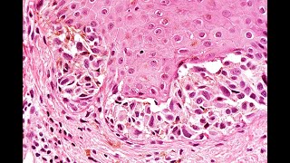 Atypical nevi Part 1 Neonatal nevi and nevus of specal sites Phillip H McKee [upl. by Nevai]