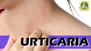 Urticaria – Remedios caseros para la urticaria  Urticaria en la piel [upl. by Nosdrahcir]