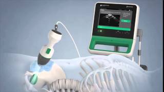 Verathon BladderScan Prime Portable Ultrasound Instrument [upl. by Yeldahc]