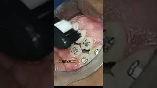 Technique de brossage des dents électrique avec brackets [upl. by Matthews26]