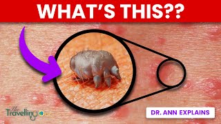 Scabies  WARNING Doctor explains Causes Symptoms and Treatments [upl. by Chesnut]