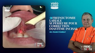 Freinectomie labiale supérieure pour correction diastème incisal  Dr Pourrat [upl. by Ahsyas595]