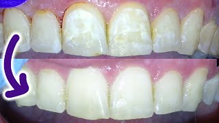 🦷 How to Remove White Spots on Teeth By A Dentist With Composite Resin Fix Decalcification Stains [upl. by Anehsak]