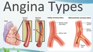 Angina pectoris types [upl. by Anigal63]