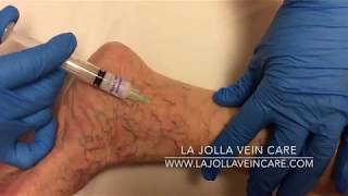 Vein Visionaries Highlighting the Best Sclerotherapy Videos of 2024 [upl. by Pain]