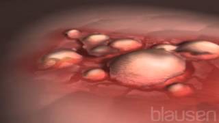 Eczema Animation [upl. by Adlin]