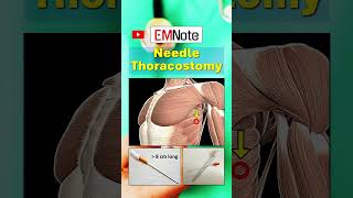 Needle Thoracostomy doctor medical trauma nursing [upl. by Aralomo]