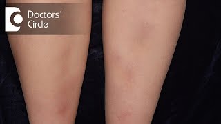 How to manage Lichen Planus present in the legs  Dr Rajdeep Mysore [upl. by Enetsirhc996]