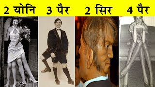 इन लोगों की कहानी सुनकर आपको रोना आ जाएगाThe Real Story Of Edward Mordrake The Man With Two Faces [upl. by Hartfield]