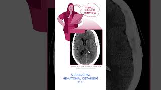 Diagnostics on Demand Subdural hematoma [upl. by Bekki961]