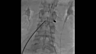 Deployment of the Amplatzer Septal Occluder [upl. by Bryn]