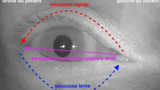 Nystagmus horizontorotatoire droit lors de la manœuvre diagnostique de DixHallpike VPPB 4ème [upl. by Sollars]