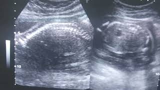 What is nuchal translucency scanHow can you know the fetus has genetic disorders [upl. by Velick773]