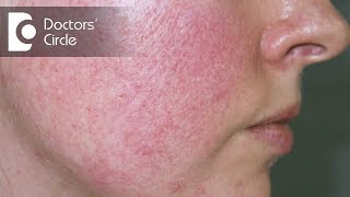 How can one manage Rosacea  Dr Rashmi Ravindra [upl. by Rosabelle136]