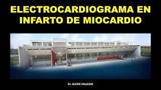 ELECTROCARDIOGRAMA EN INFARTO DE MIOCARDIO II [upl. by Sirdna]