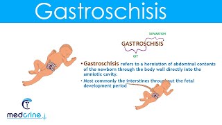 Gastroschisis Definition Causes and Diferences with Omphalocele [upl. by Marelda]