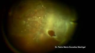 Vitrectomy for Rhegmatogenous Retinal detachment with PVR [upl. by Eeslek]