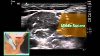 UltrasoundGuided Interscalene Brachial Plexus Nerve Block  SonoSitemp4 [upl. by Laeynad]