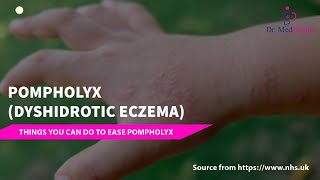 Pompholyx  Dyshidrotic eczema  dyshidrotic eczema treatment [upl. by Coyle777]