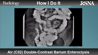 Air C02 DoubleContrast Barium Enteroclysis How I Do It [upl. by Diahann]