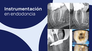 Instrumentación en Endodoncia qué conicidad debes emplear en tus limas [upl. by Veriee]