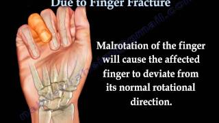 Finger Fractures Malrotation Of The Fingers  Everything You Need To Know  Dr Nabil Ebraheim [upl. by Huberto]