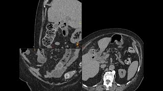 Cholecystoenteric fistula and gallstone small bowel obstruction [upl. by Tristis]