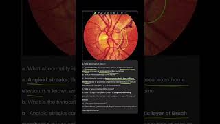 Case 15  Angioid streaks [upl. by Ahern512]