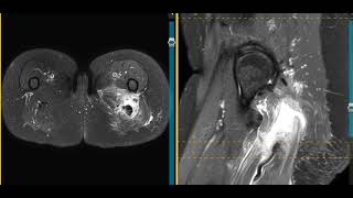 Hamstring tendon tear [upl. by Arimlede]