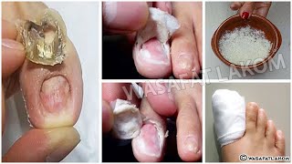 Do you suffer from nail fungus You have to do this  VERY IMPORTANT TIP [upl. by Tila]