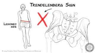 The Trendelenberg Sign HD [upl. by Enrobso162]