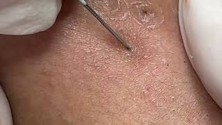 Relaxing With NaSa Da Nang Spa Beauty Blackheads Acne Extraction Date Nov162024 2 [upl. by Suirad]