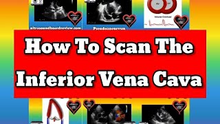 Scanning the Inferior Vena Cava Using Ultrasound [upl. by Nowyt878]