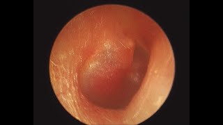 Glomus tympanicum middle ear paraganglioma [upl. by Delle773]