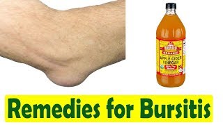 How to Cure Bursitis  Home Remedies for Bursitis [upl. by Coonan]