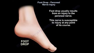 Foot Drop peroneal nerve Injury [upl. by Ymaj]