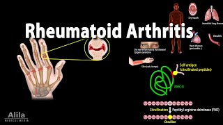 Rheumatoid Arthritis Animation [upl. by Gillead437]