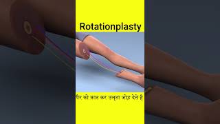 Rotationplasty surgery 3D video [upl. by Halil]