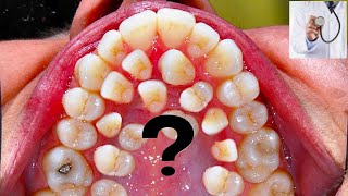 MORE THAN 500 TEETH I Hyperdontia I Gardner syndrome supernumerary teeth ISabaceous Cysts [upl. by Nirda]