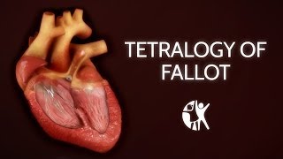 Tetralogy of Fallot  Cincinnati Childrens [upl. by Yzus886]