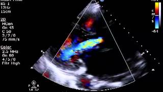 Aortic amp Mitral Regurgitation [upl. by Euqinom]