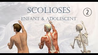 ▶️ Redresser les SCOLIOSES sans corset 2  exemples [upl. by Hewie]