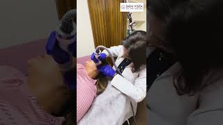 Microneedling Radio Frequency MNRF Skincare Treatment at Skin Vista acnescarstreatment mnrf [upl. by Grannie506]